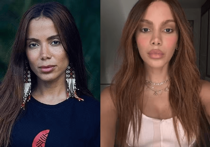 O que Anitta fez no rosto? Especialista cita procedimentos que podem chegar a R$ 120 mil
