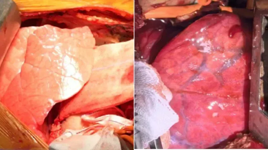 Pulmão de porco geneticamente modificado é transplantado em homem em experimento inédito.